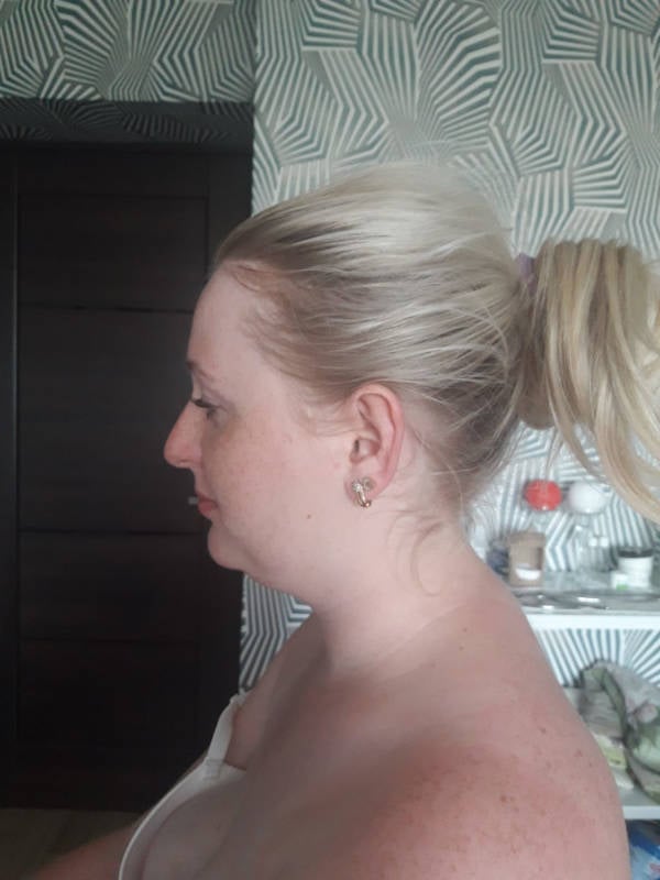 anti-cellulite-massage-vorher